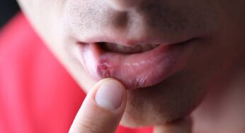 Herpes Zoster o Culebrilla