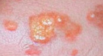 El molusco contagioso