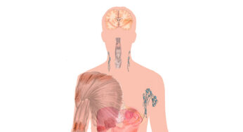 Fibromialgia