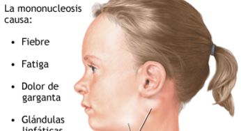 MONONUCLEOSIS INFECCIOSA