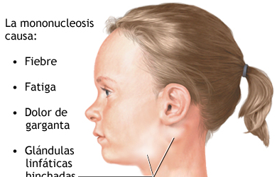 MONONUCLEOSIS INFECCIOSA