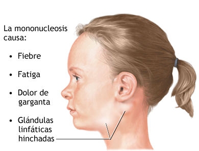 MONONUCLEOSIS INFECCIOSA