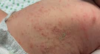 ESCABIOSIS