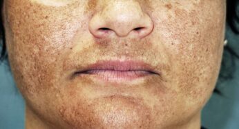 MELASMA Y SU TRATAMIENTO