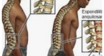 ESPONDILITIS ANQUILOSANTE