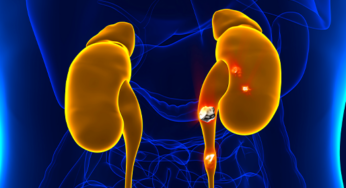 ENFERMEDAD LITIÁSICA RENAL: CAUSAS, SÍNTOMAS Y TRATAMIENTO