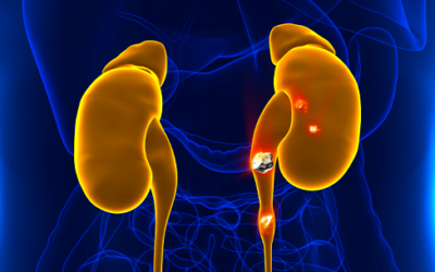 ENFERMEDAD LITIÁSICA RENAL: CAUSAS, SÍNTOMAS Y TRATAMIENTO