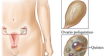 SÍNDROME DE OVARIOS POLIQUÍSTICOS