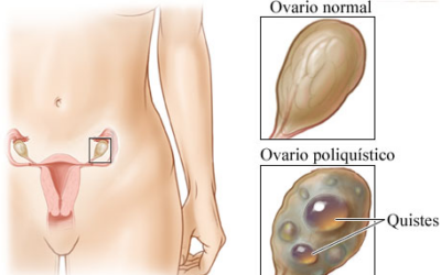 SÍNDROME DE OVARIOS POLIQUÍSTICOS