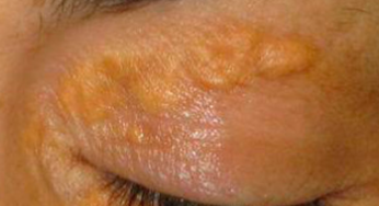 XANTELASMA