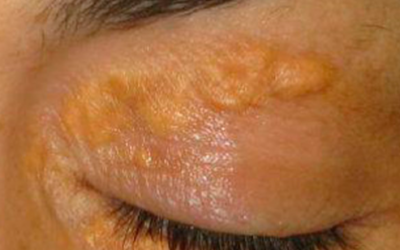 XANTELASMA