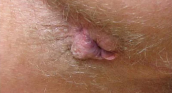 HEMORROIDES: SÍNTOMAS, DIAGNÓSTICO Y TRATAMIENTO