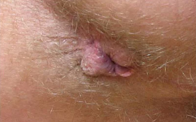 HEMORROIDES: SÍNTOMAS, DIAGNÓSTICO Y TRATAMIENTO