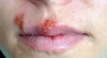 INFECCIÓN POR HERPES VIRUS TIPO 1 (HSV-1)