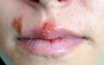 INFECCIÓN POR HERPES VIRUS TIPO 1 (HSV-1)
