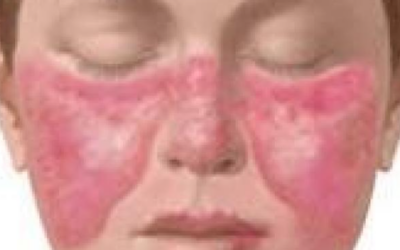 LUPUS ERITEMATOSO SISTÉMICO
