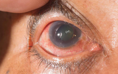 GLAUCOMA