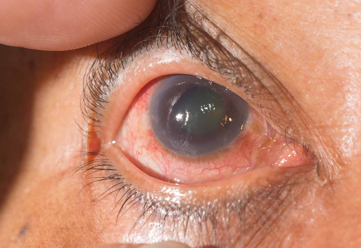 GLAUCOMA