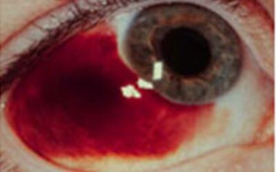 HEMORRAGIA SUBCONJUNTIVAL 
