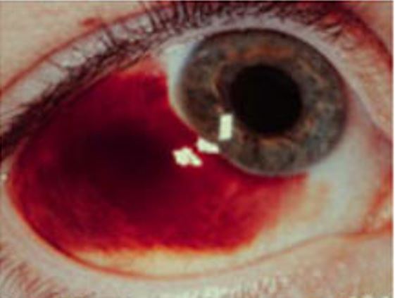 HEMORRAGIA SUBCONJUNTIVAL