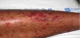 MANIFESTACIONES DERMATOLOGICAS DE ENFERMEDADES SITEMICAS