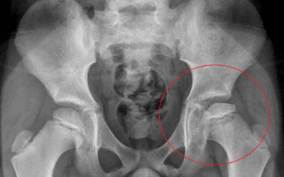 ENFERMEDAD Legg-Calvé-Perthes