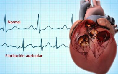 FIBRILACION AURICULAR