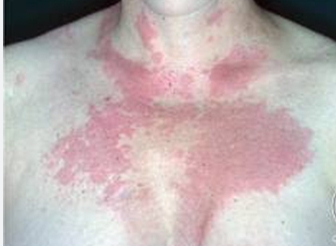 DERMATOMIOSITIS: CAUSAS, SÍNTOMAS, DIAGNÓSTICO Y TRATAMIENTO