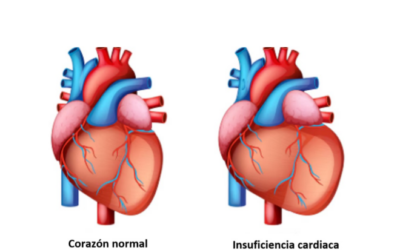 INSUFICIENCIA CARDÍACA