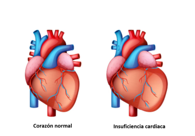 INSUFICIENCIA CARDÍACA