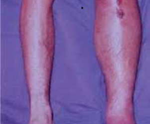 SÍNDROME COMPARTIMENTAL