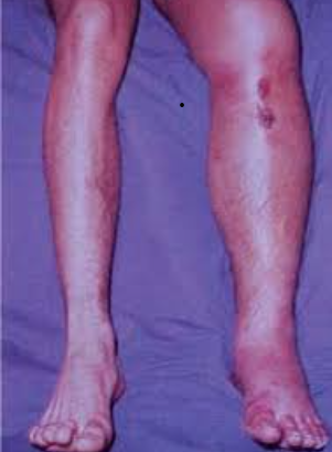 SÍNDROME COMPARTIMENTAL