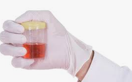 HEMATURIA, DIAGNÓSTICO Y TRATAMIENTO