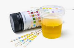 PROTEINURIA, DIAGNÓSTICO Y TRATAMIENTO