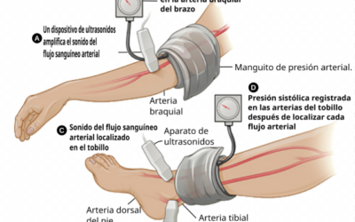 ÍNDICE TOBILLO-BRAZO (ITB)