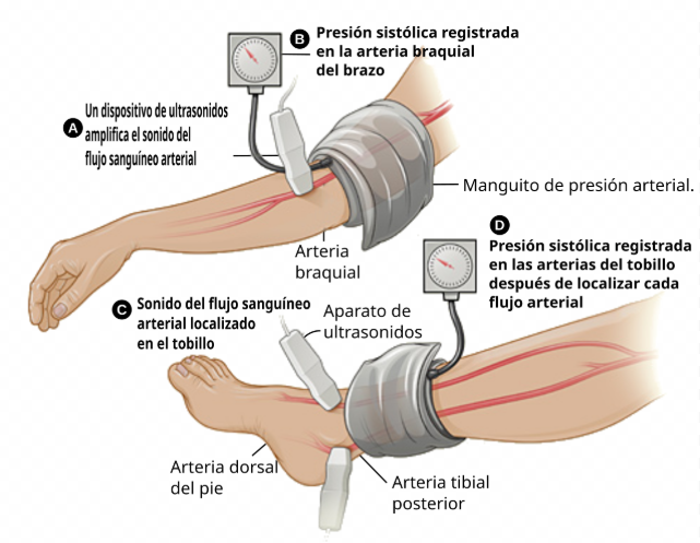 ÍNDICE TOBILLO-BRAZO (ITB)