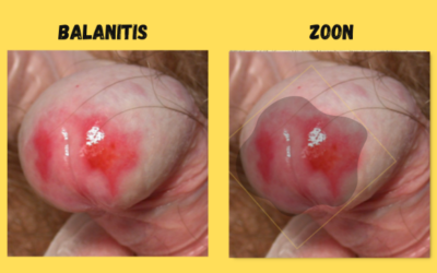 BALANITIS