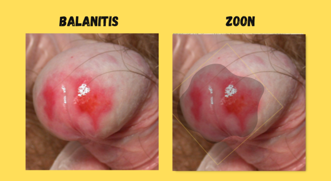 BALANITIS