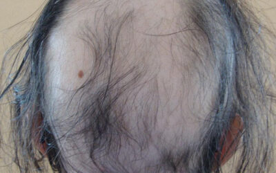 ALOPECIA AREATA