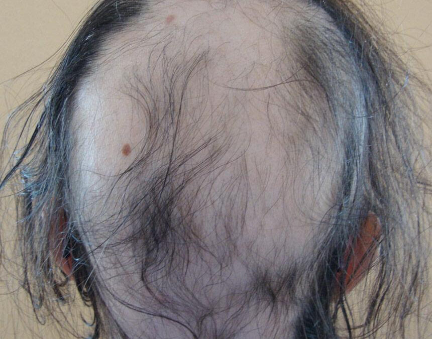 ALOPECIA AREATA