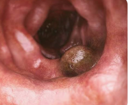 CÁNCER DE COLON 