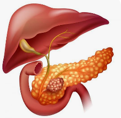 CÁNCER DE PÁNCREAS