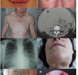 AMILOIDOSIS: UNA ENFERMEDAD POR DEPÓSITO DE PROTEÍNAS CON MÚLTIPLES MANIFESTACIONES CLÍNICAS